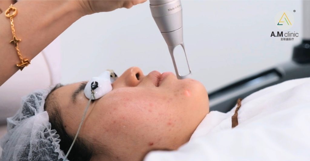 AM Pico Laser Treatment